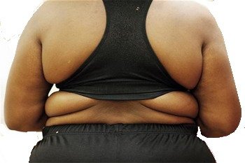 השמנת-יתר מקצרת את תוחלת החיים